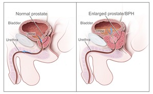 Top NYC Urologist Benign Prostatic Hyperplasia BPH 01