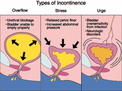 doctor in nyc for Urinary incontinence in men p03