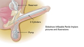 Penis Pump - Comprehensive Urology