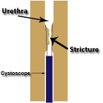 Urethral Strictures