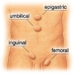 abdominal hernia in adults