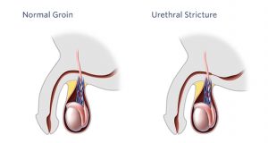 urethral-stricture