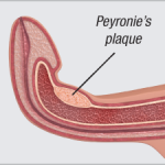 peyronie's