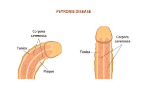 peyronie-disease