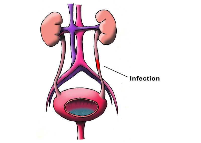 Urinary Tract Infections Top Urologist NYC