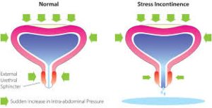 Urinary Incontinence: Men Vs. Women - Top Urologist Nyc