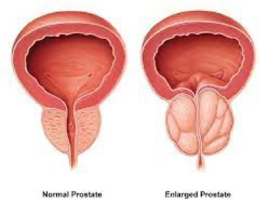 What are the Symptoms of Benign Prostatic Hyperplasia (BPH)? - Top