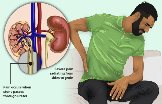 Treating Kidney Stones Best